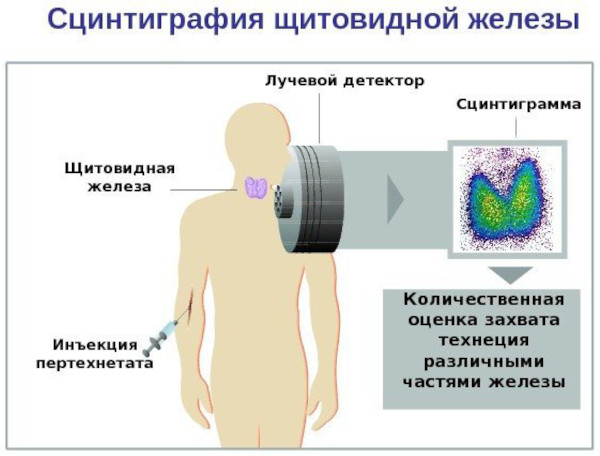 ТТГ низкий Т4 высокий. Диагноз, что это значит, как лечить