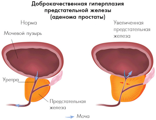 Гимнастика кегеля для мужчин при недержании мочи картинки