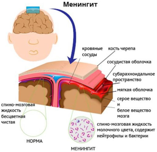 Вакцина от менингита для детей. Названия, отзывы, какая лучше