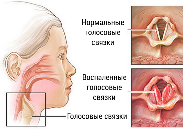 Аллергический ларингит. Лечение у ребенка, симптомы, препараты