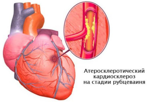 Аневризма сердца. Что это такое, симптомы, лечение