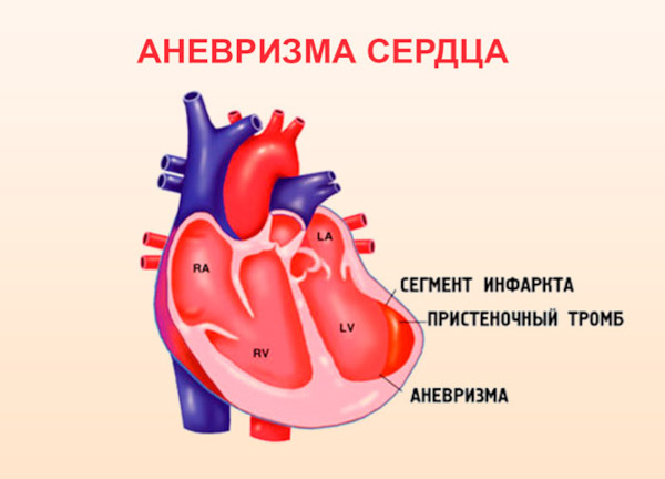 Аневризма сердца. Что это такое, симптомы, лечение