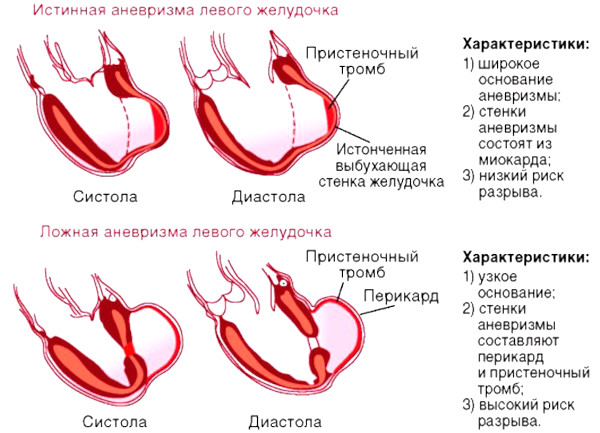 Аневризма сердца. Что это такое, симптомы, лечение