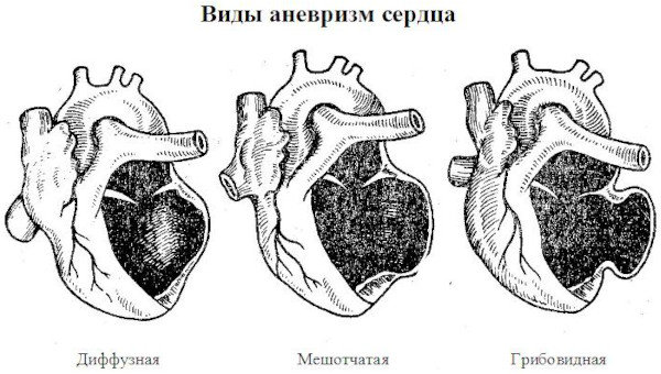 Аневризма сердца. Что это такое, симптомы, лечение