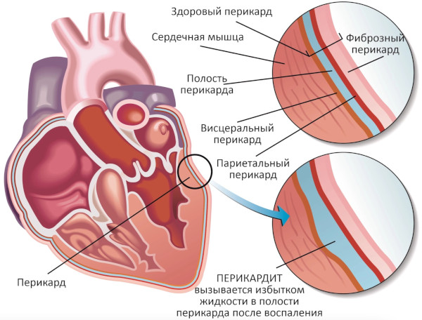 Аневризма сердца. Что это такое, симптомы, лечение