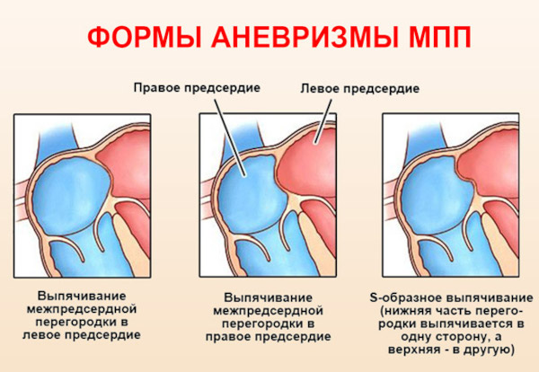 Аневризма сердца. Что это такое, симптомы, лечение