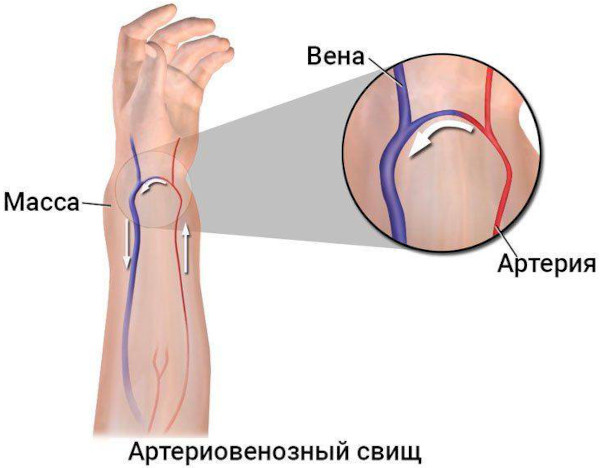 Артериовенозный свищ (артериовенозная фистула)