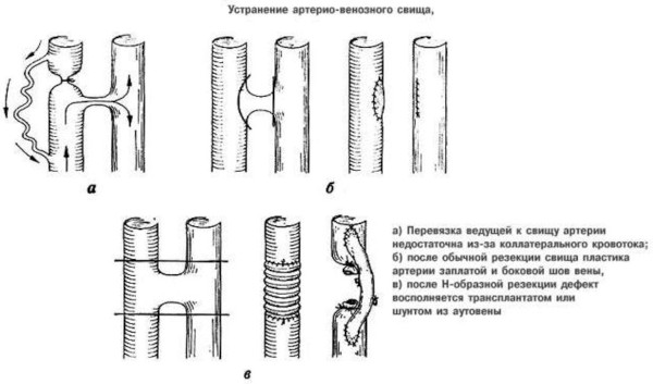 Артериовенозный свищ (артериовенозная фистула)