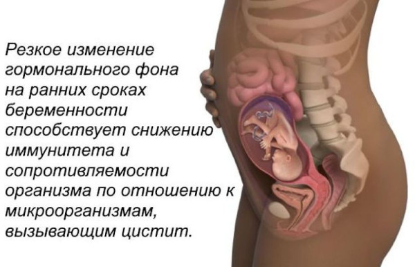 Боли в пояснице при цистите. Как, сколько болит у женщин, что делать