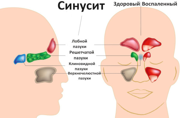 Cинусит и гайморит: разница воспаления носовых пазух, симптомы