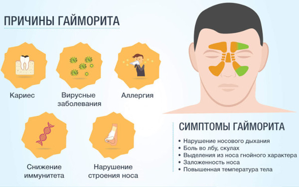 Cинусит и гайморит: разница воспаления носовых пазух, симптомы