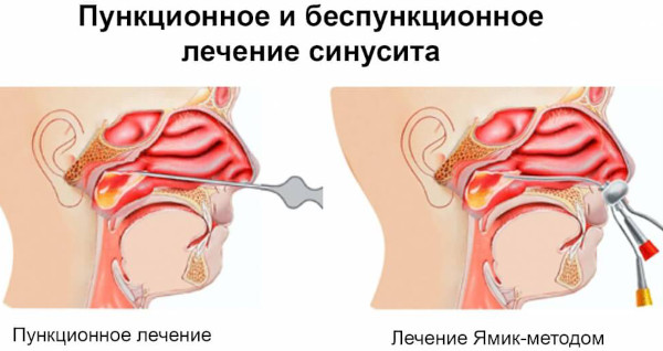 Cинусит и гайморит: разница воспаления носовых пазух, симптомы