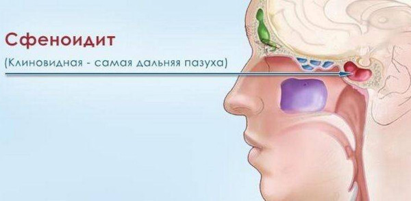 Cинусит и гайморит: разница воспаления носовых пазух, симптомы