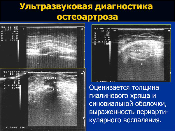 Диагностика остеоартроза: анализы, рентген, УЗИ, МРТ