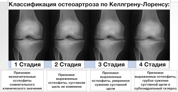 Диагностика остеоартроза: анализы, рентген, УЗИ, МРТ