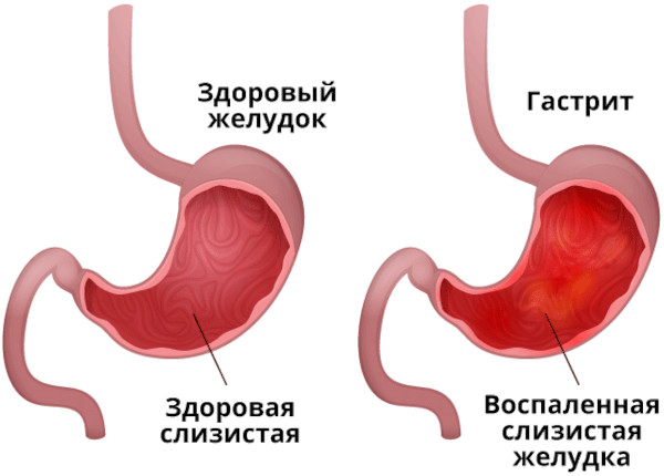 Гастроэнтерология. Что это в медицине, что лечит, заболевания