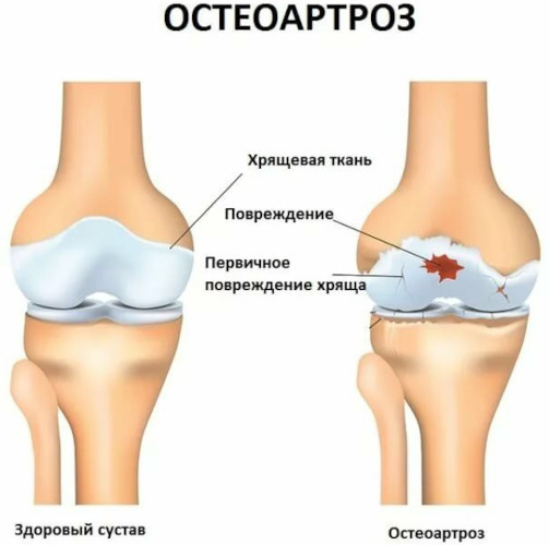 Генерализованный остеоартроз. Что это такое, как лечить