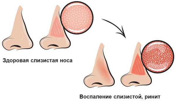 Гнойные выделения из носа, желтые густые сопли, запах гноя. Чем лечить