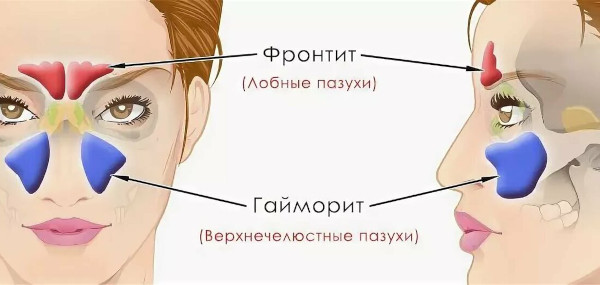 Гнойные выделения из носа, желтые густые сопли, запах гноя. Чем лечить