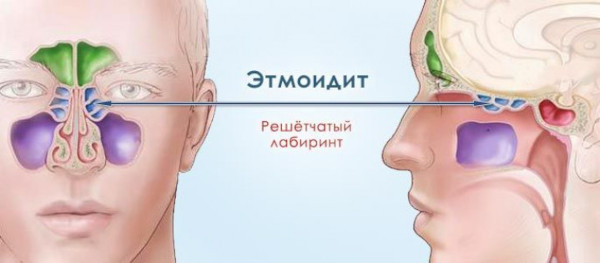 Гнойные выделения из носа, желтые густые сопли, запах гноя. Чем лечить