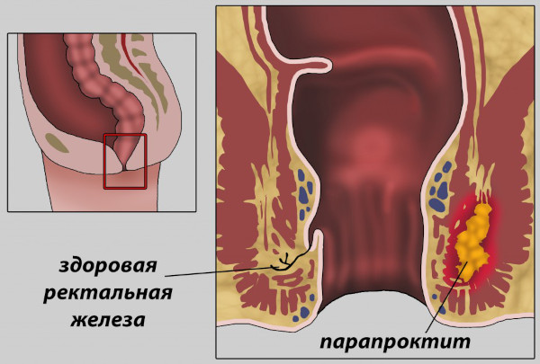 Интрасфинктерный свищ после парапроктита. Операция по удалению