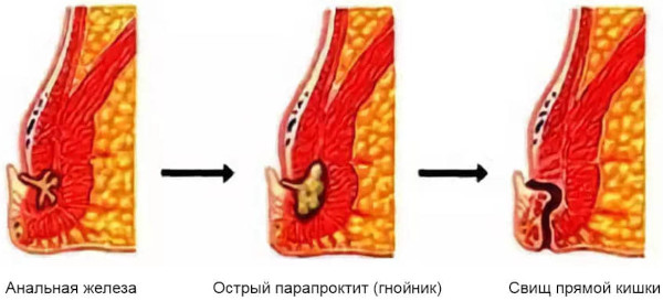 Интрасфинктерный свищ после парапроктита. Операция по удалению