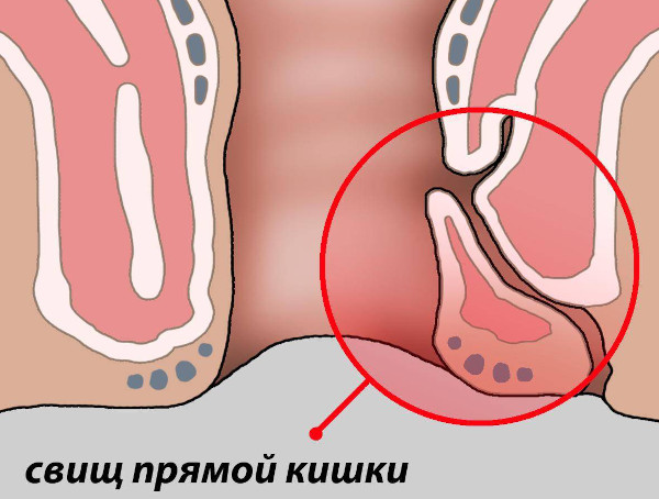 Интрасфинктерный свищ после парапроктита. Операция по удалению