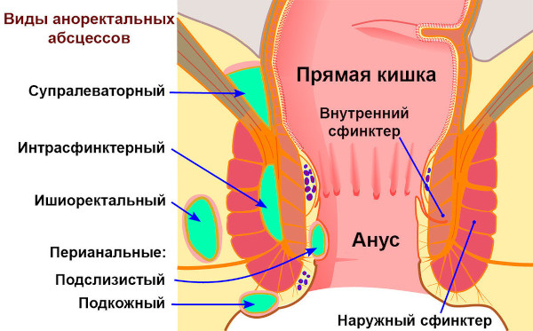 Интрасфинктерный свищ после парапроктита. Операция по удалению