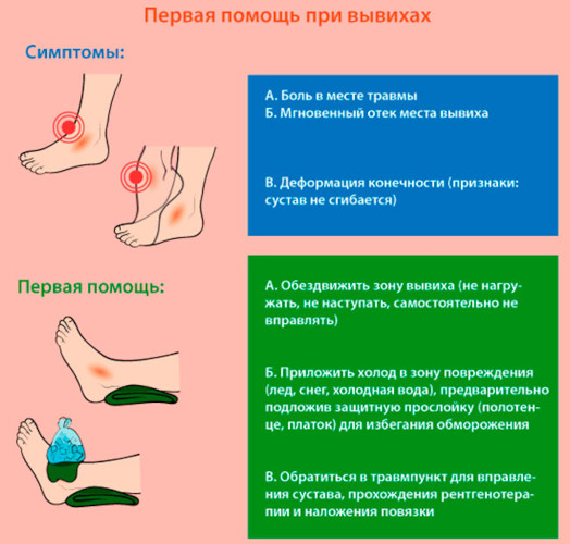 Что делать при растяжении связок стопы