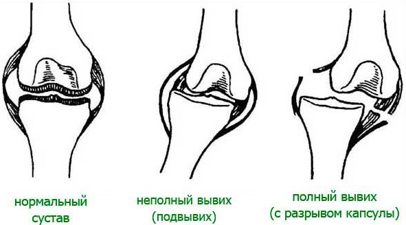 Как определить вывих или растяжение, как отличить травму плеча, стопы, связок, колена, запястья, ноги