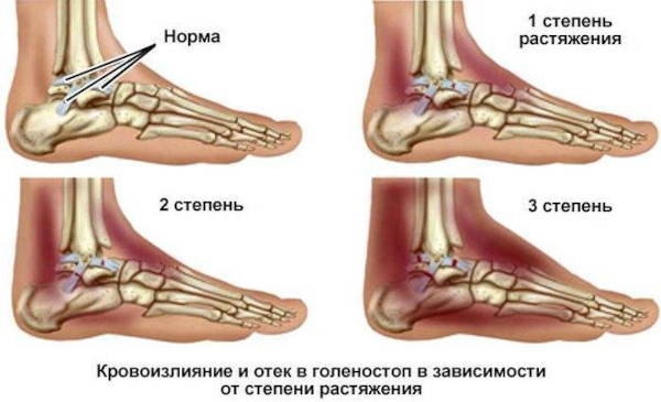 Как определить вывих или растяжение, как отличить травму плеча, стопы, связок, колена, запястья, ноги