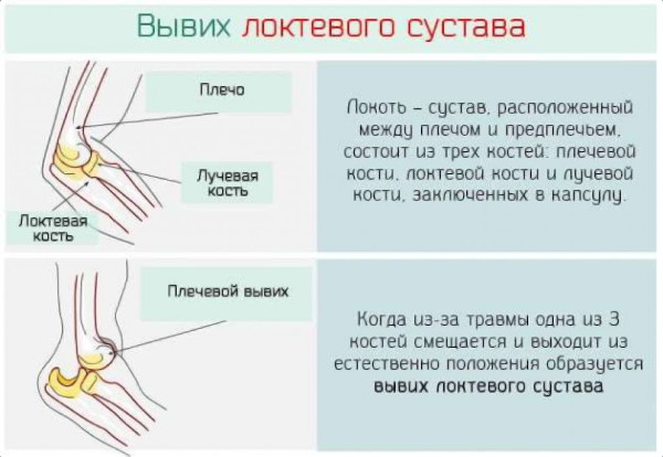 Как определить вывих или растяжение, как отличить травму плеча, стопы, связок, колена, запястья, ноги