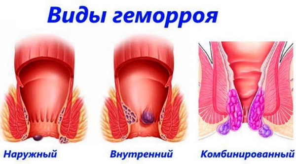 Как понять, что у тебя геморрой. Симптомы внутреннего геморроя, температура