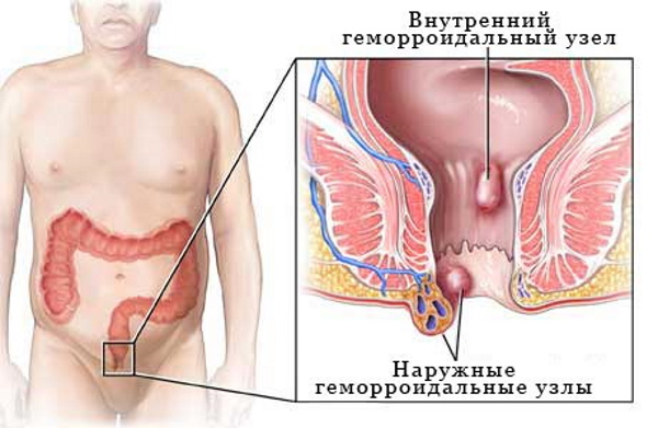 Как понять, что у тебя геморрой. Симптомы внутреннего геморроя, температура