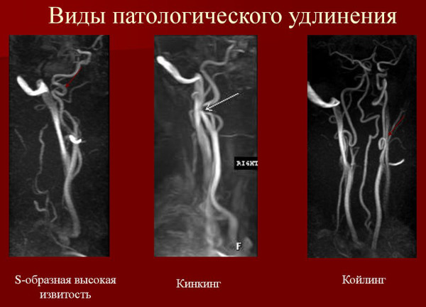 Кинкинг (извитость) позвоночных артерий. Что это, симптомы и лечение