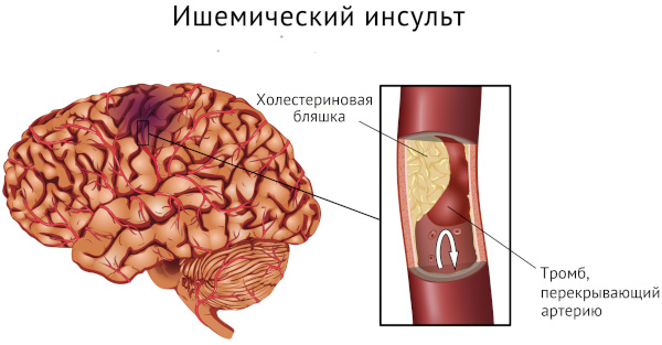 Кинкинг (извитость) позвоночных артерий. Что это, симптомы и лечение