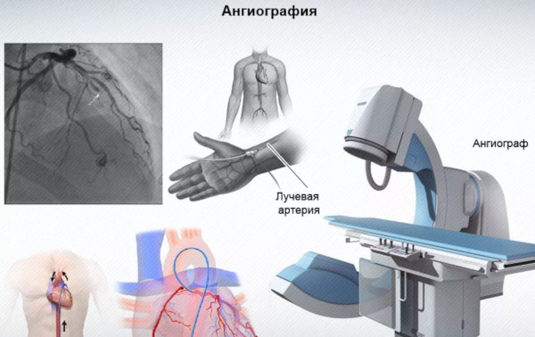 Реваскуляризация миокарда коронарная. Что это такое