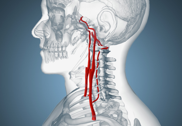 Кинкинг (извитость) позвоночных артерий. Что это, симптомы и лечение
