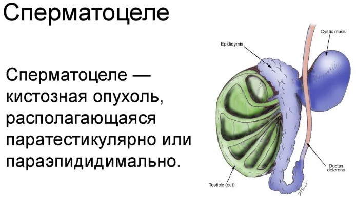 Придаток яичка у мужчин фото