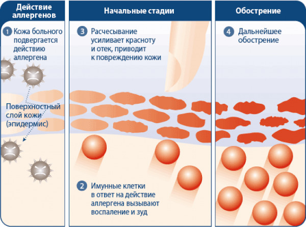 Лечение кожных заболеваний: препараты, мази-антибиотики, народные средства