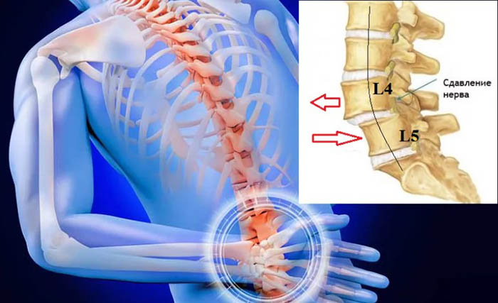 Листез поясничного отдела позвоночника