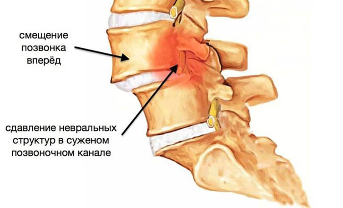 Листез поясничного отдела позвоночника