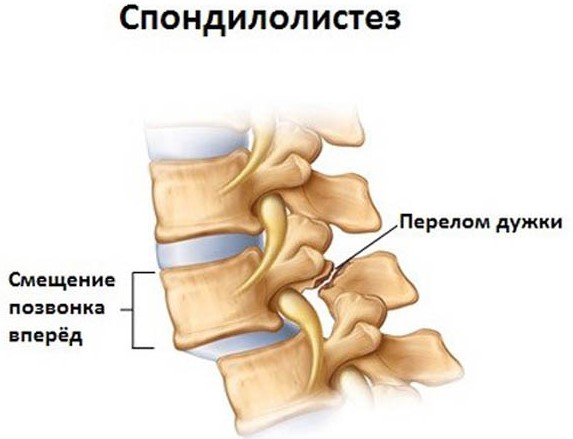 Листез поясничного отдела позвоночника