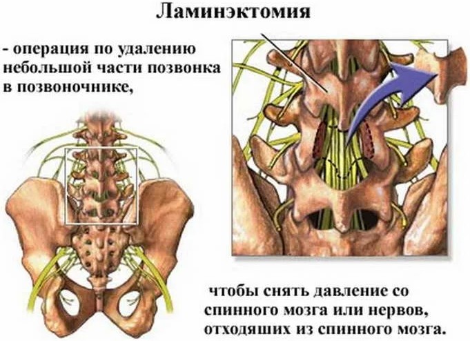 Листез поясничного отдела позвоночника