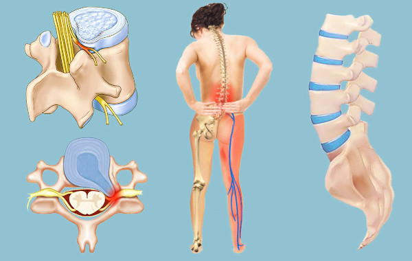 Люмбаго с ишиасом. Что это такое, как лечить болезнь, симптомы