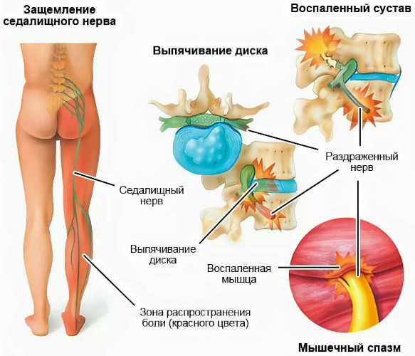 Люмбаго с ишиасом. Что это такое, как лечить болезнь, симптомы