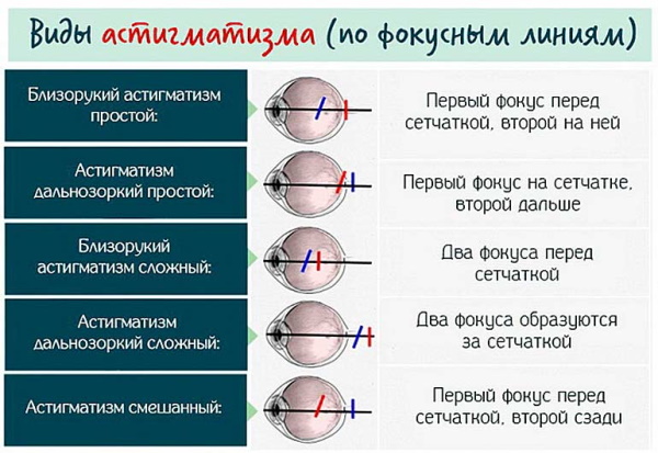 Обратный астигматизм и прямой. Что это такое, тип сложный миопический