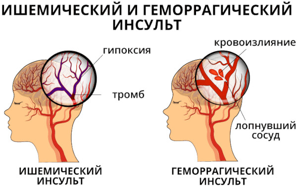 Органы мишени при гипертонической болезни артериальная гипертензия. Признаки поражения