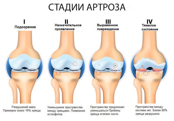 Остеоартроз позвоночника (артроз поясничного отдела). Что это такое, симптомы, лечение