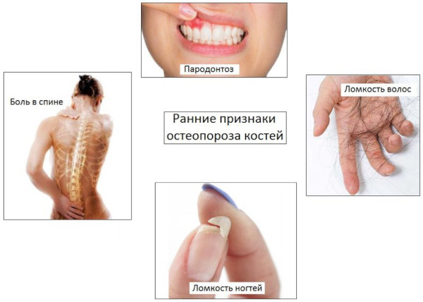 Остеопороз пятнистый: кости на рентгенограмме, КТ, что это такое, лечение